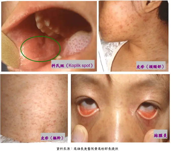 清明連假將至 防麻疹境外移入不可大意