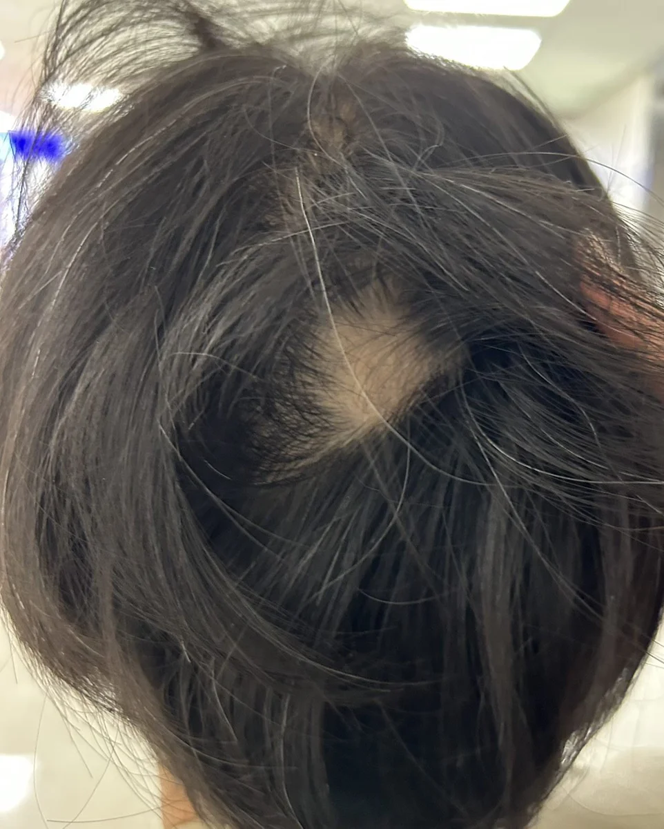 頭髮突然禿一塊?中醫破解「鬼剃頭」成因 3招找回茂密秀髮