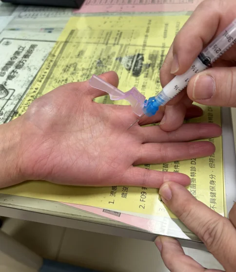 起床手指僵硬卡住?北市聯醫揭「扳機指」治療解方:經皮鬆解術免開大刀